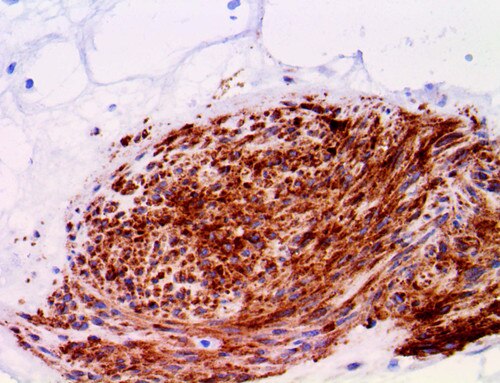 IHC of DOG-1 Rmab on an FFPE GIST Tissue